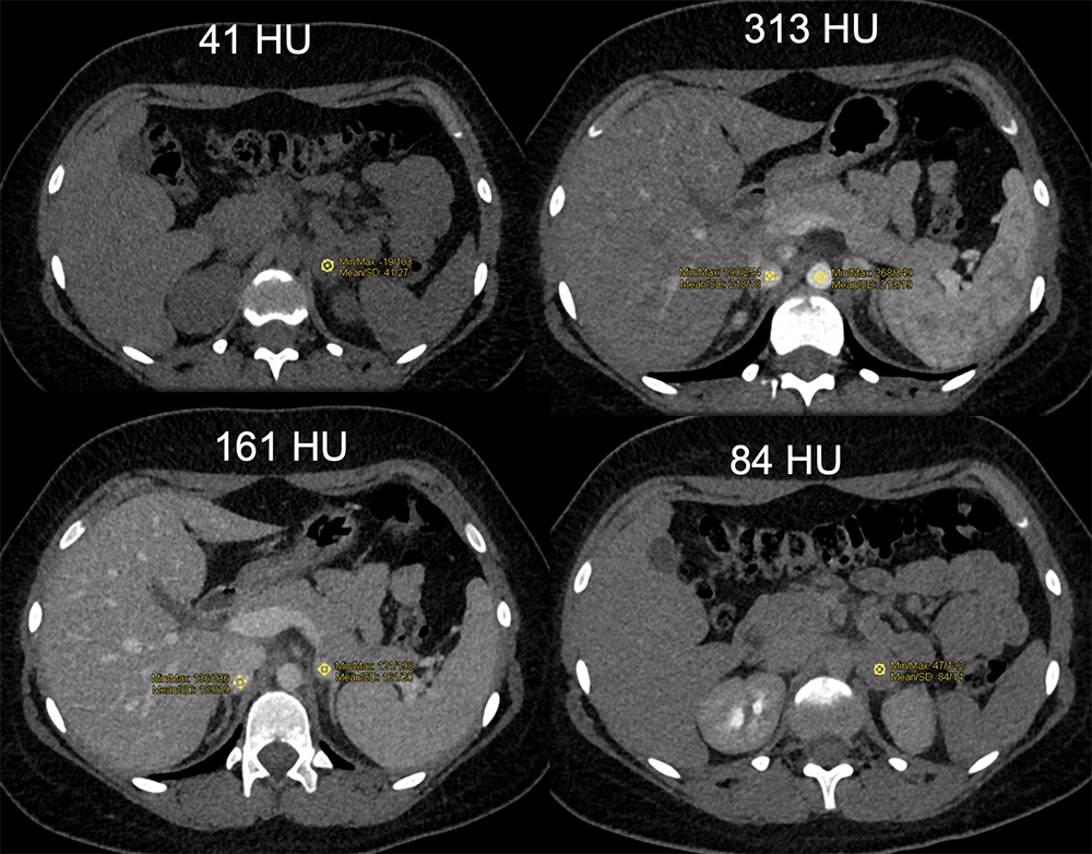 Adrenal Pheochromocytoma