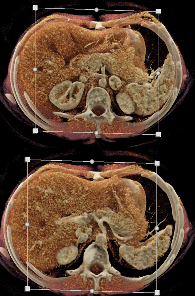 Adrenal Pheochromocytoma