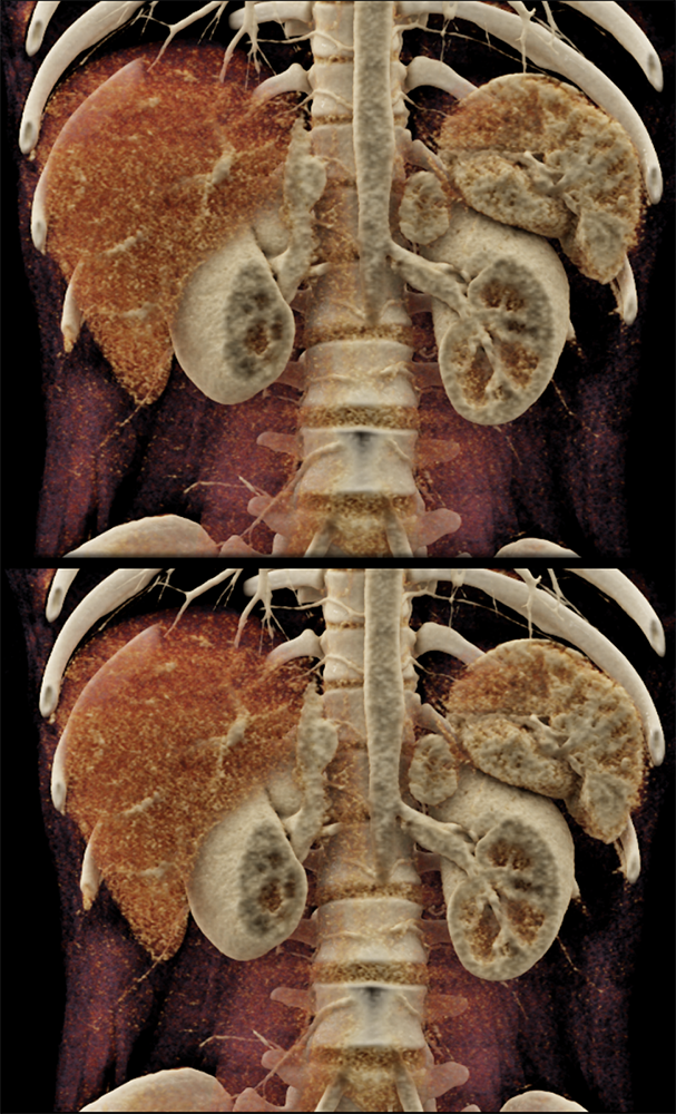 Adrenal Pheochromocytoma