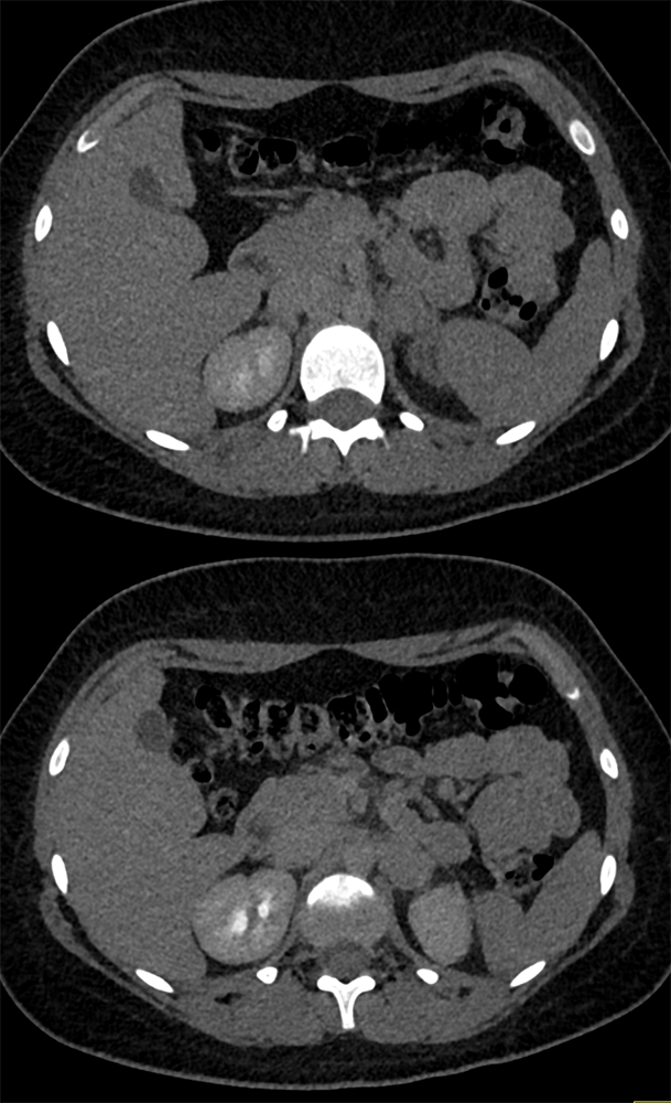 Adrenal Pheochromocytoma