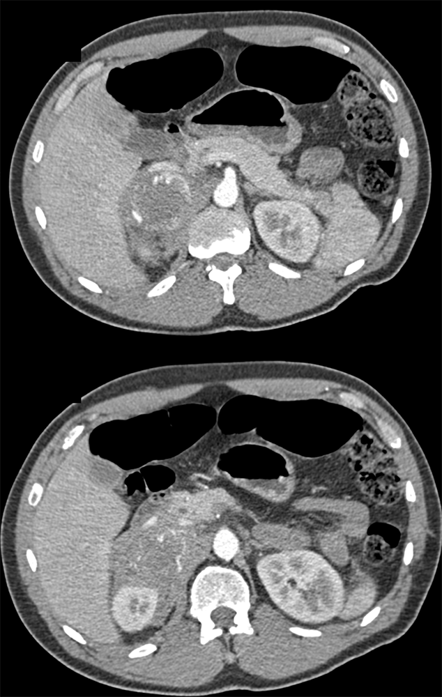 Infiltrating Pheochromocytoma