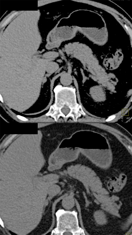 1 cm Pheochromocytoma