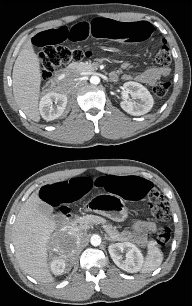 Adrenal Pheochromocytoma