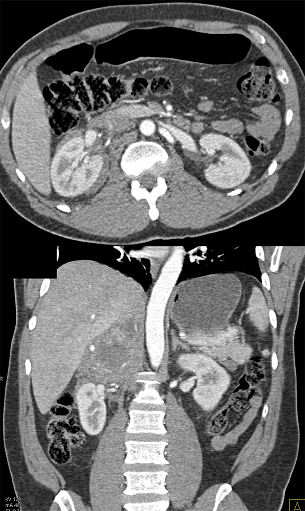 Adrenal Pheochromocytoma