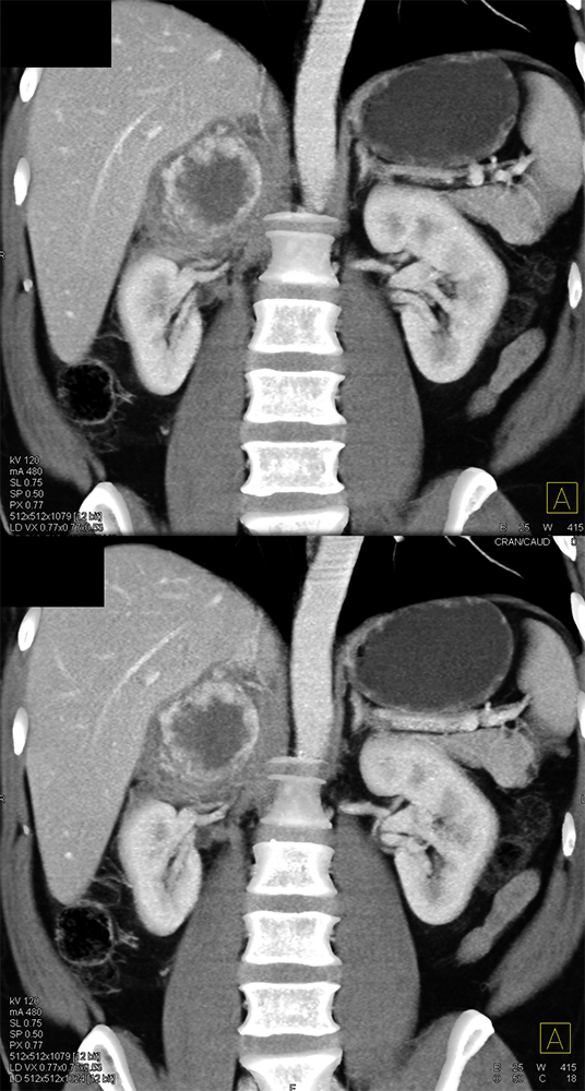 Adrenal Pheochromocytoma