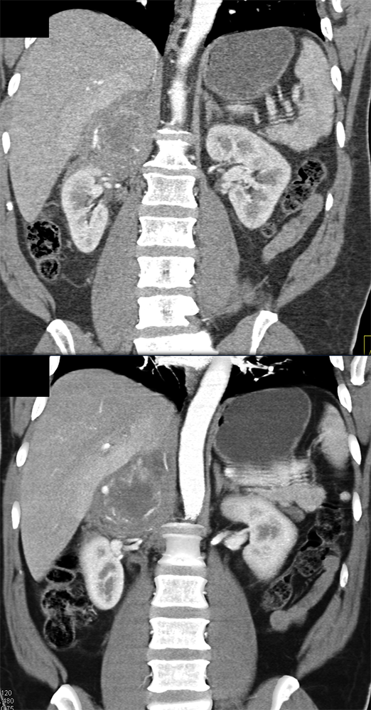 Adrenal Pheochromocytoma