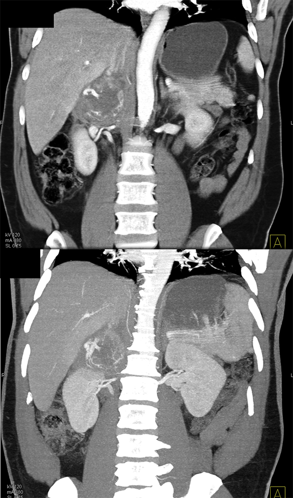 Adrenal Pheochromocytoma