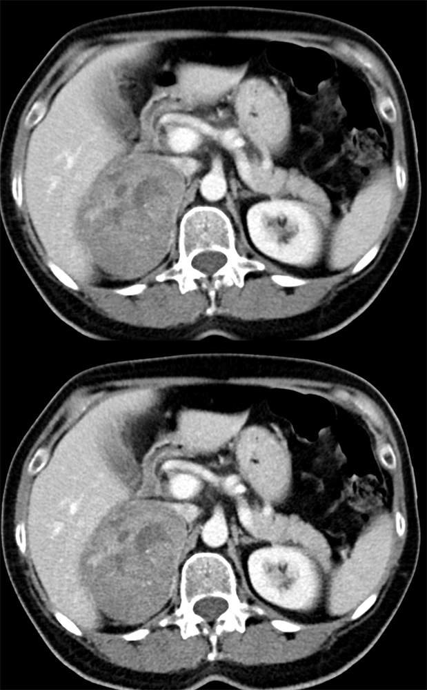 Bleed in a Pheochromocytoma