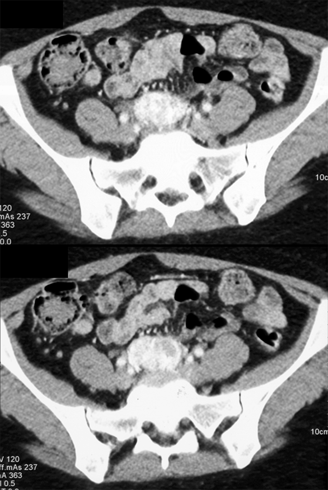 Extra-Adrenal Pheochromocytoma