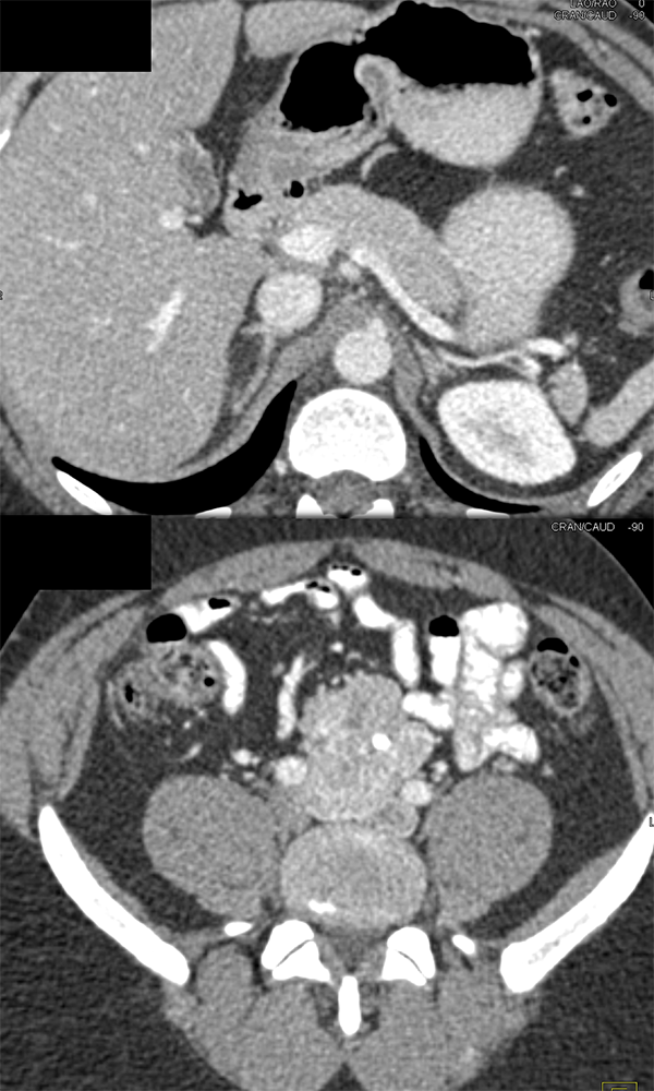 Pheochromocytoma in Organ of Zuckerkandl