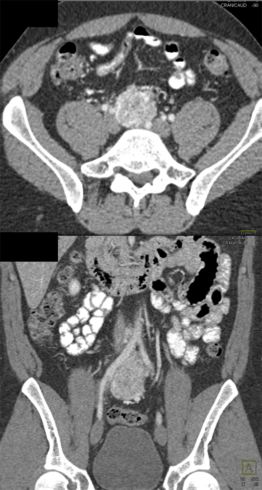 Adrenal Pheochromocytoma