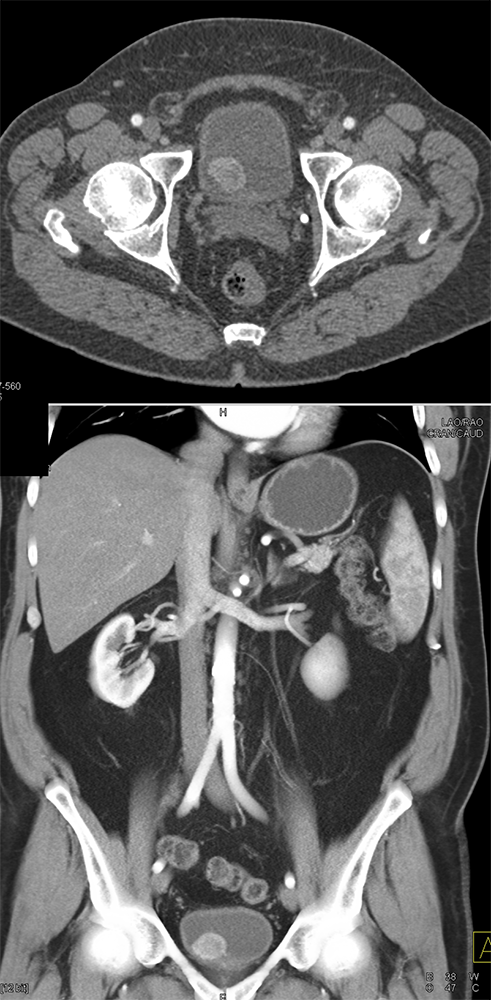 Bladder Pheochromocytoma