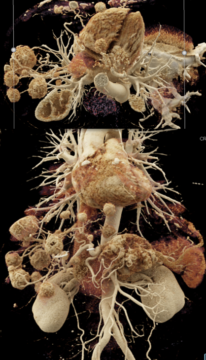 Case 7: PNET with Hepatic Metastases and Splenic Vein Occlusion