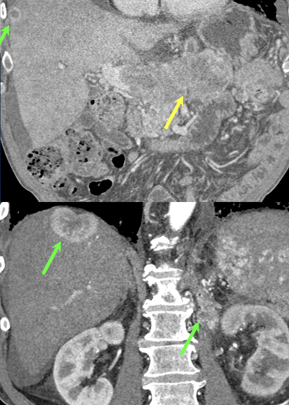 Case 8: PNET with Metastases and Vascular Involvement 