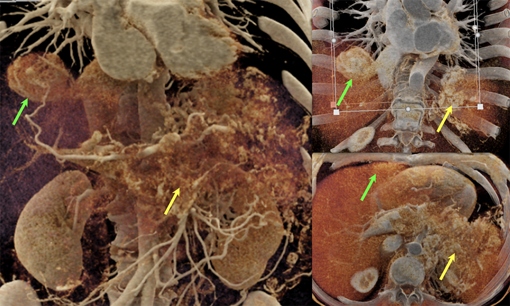 Case 8: PNET with Metastases and Vascular Involvement  (cont’d)