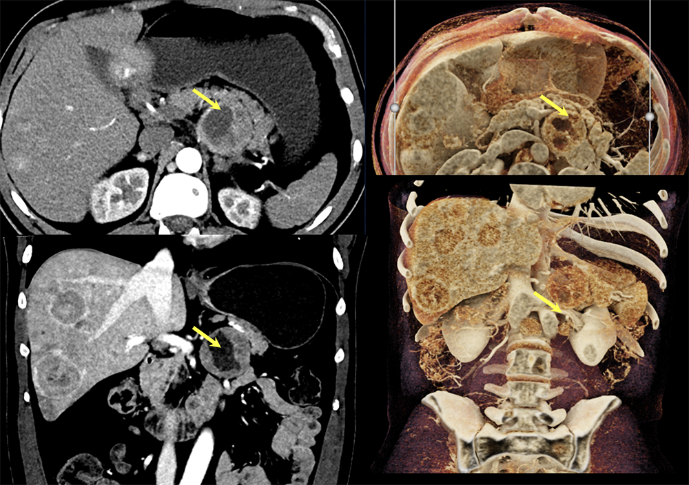 Case 12: PNET with Central Necrosis 