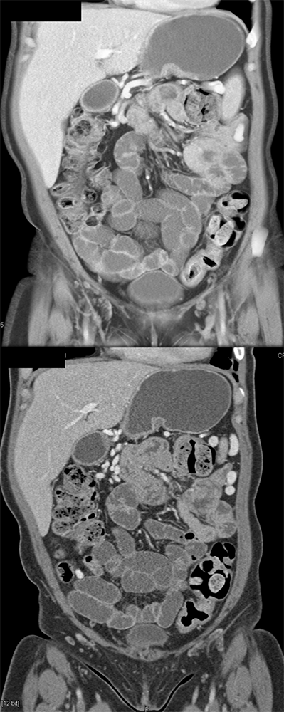 Dilated SB with VoLumen