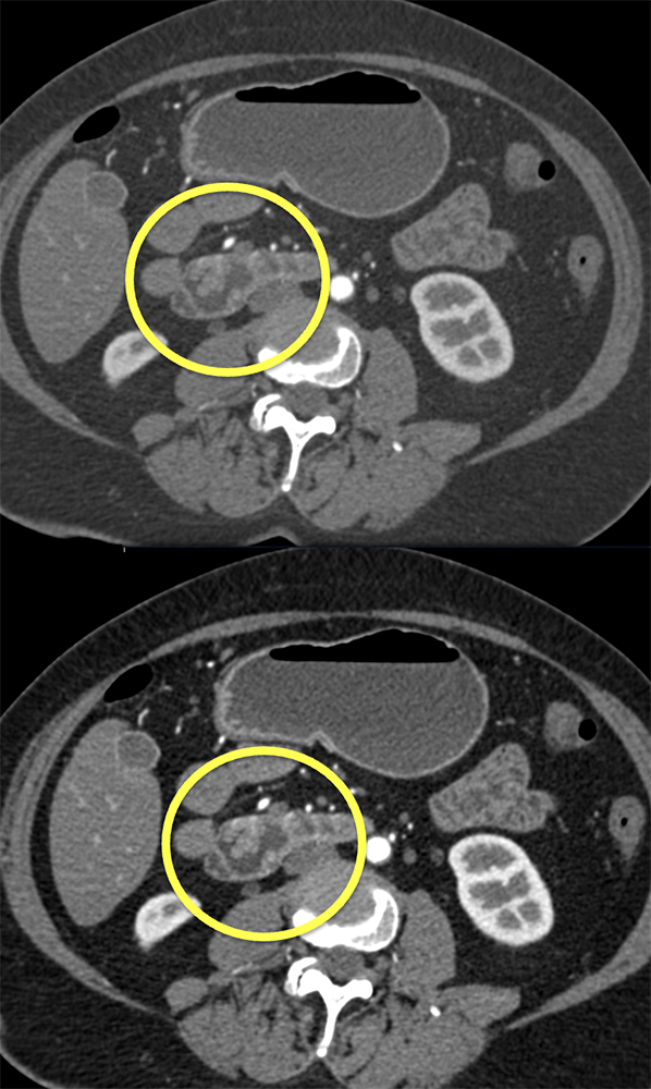 Duodenal Polyps due to Polyposis Syndrome 