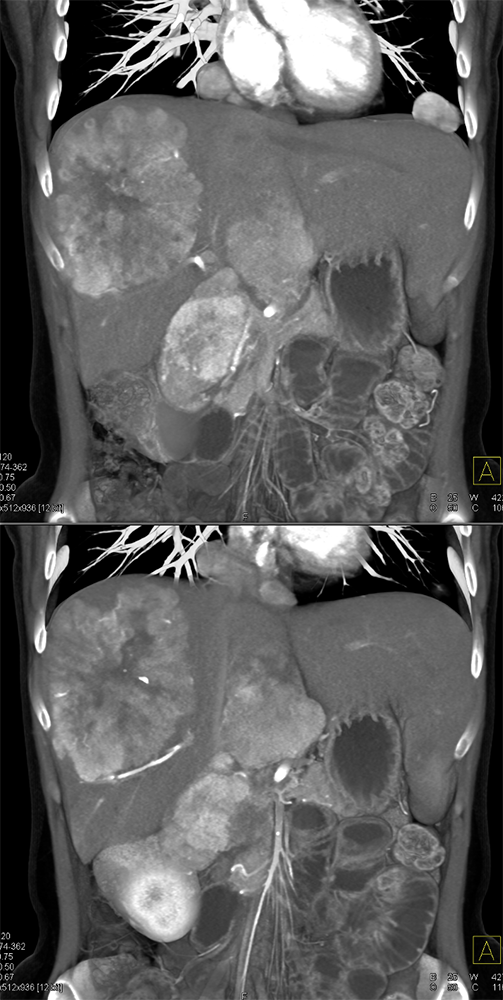 Metastatic Neuroendocrine Tumor