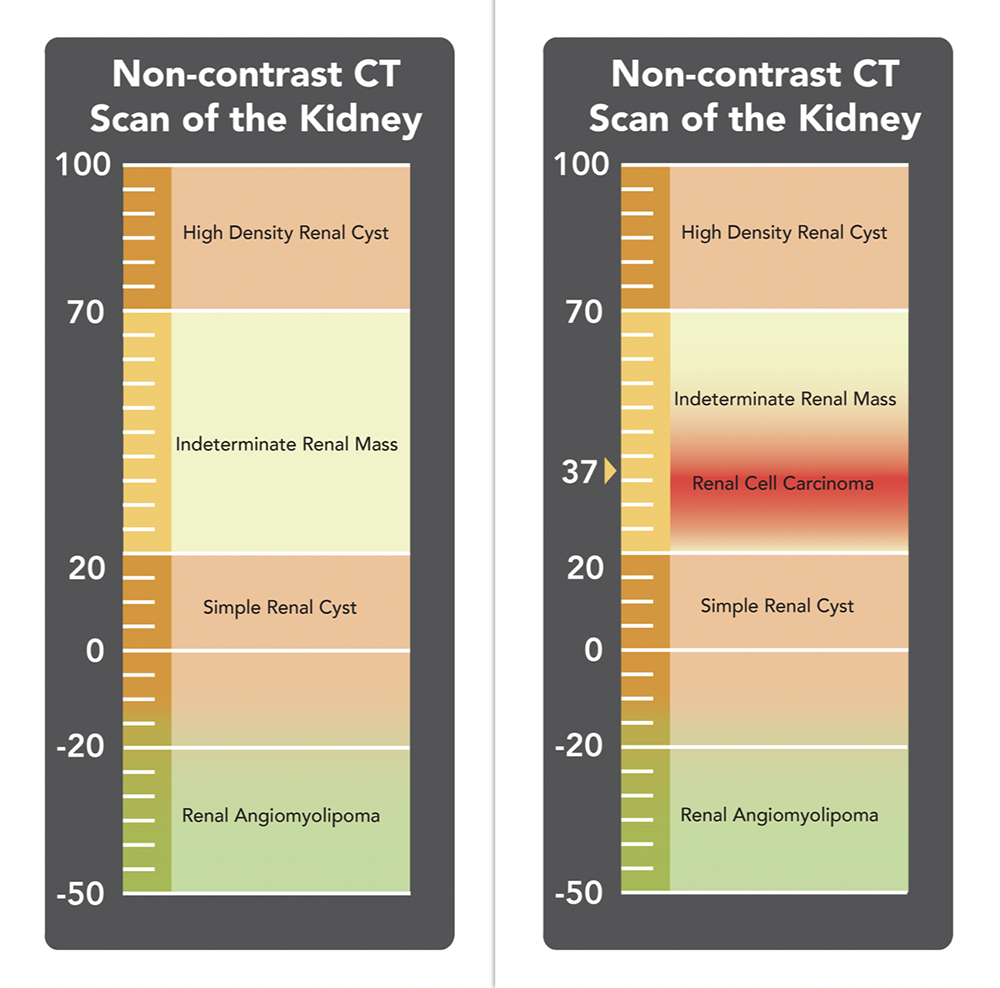 CT of Renal Masses