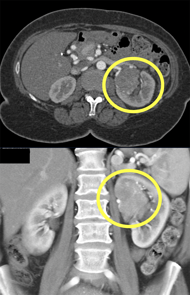 CT of Renal Masses