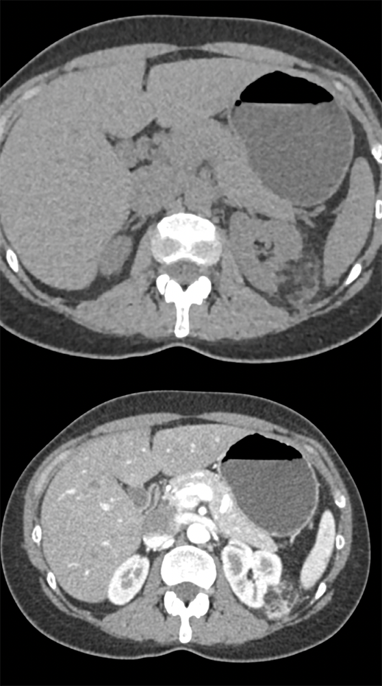 Renal Angiomyolipoma