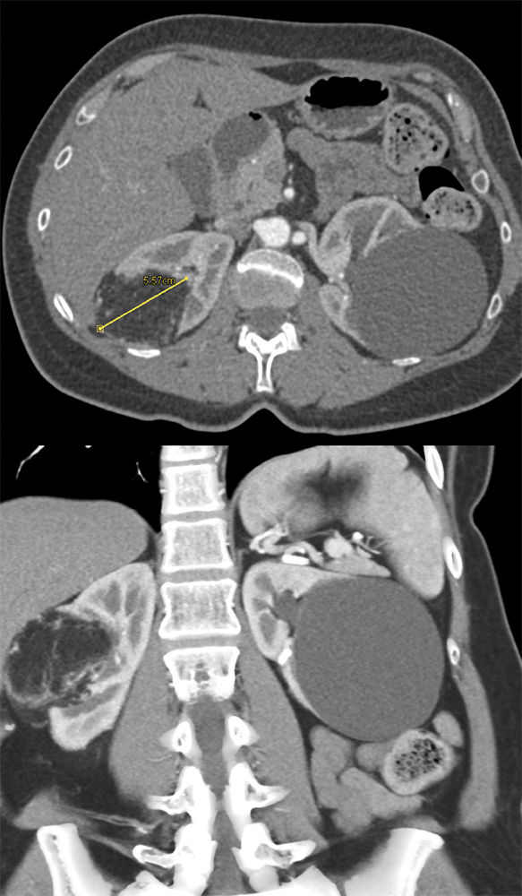 Renal Angiomyolipoma