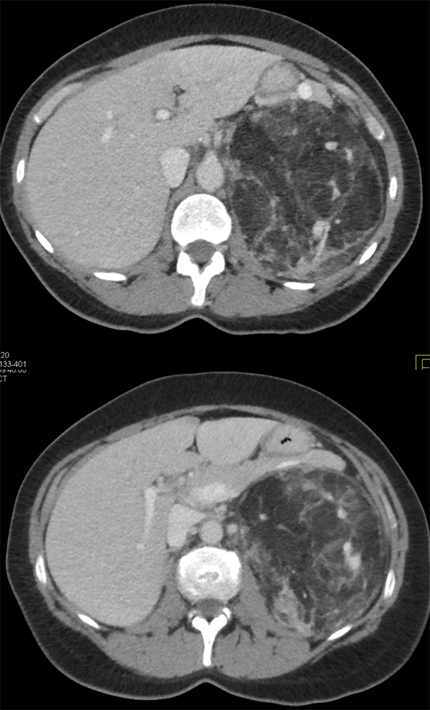 Renal Angiomyolipoma