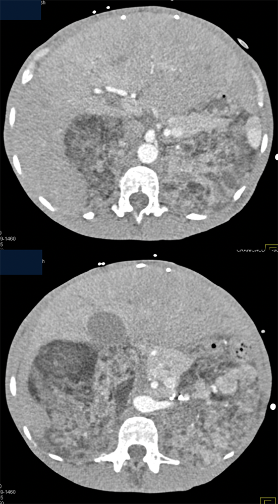 Tuberous Sclerosis and Bilateral AMLs