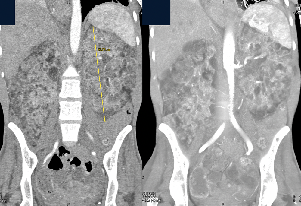 CT of Renal Masses