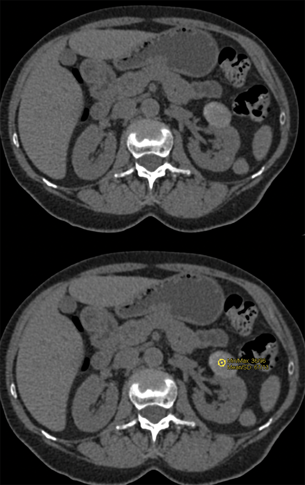 High Density Renal Cyst