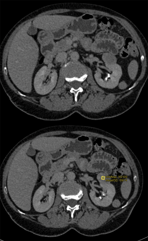 CT of Renal Masses