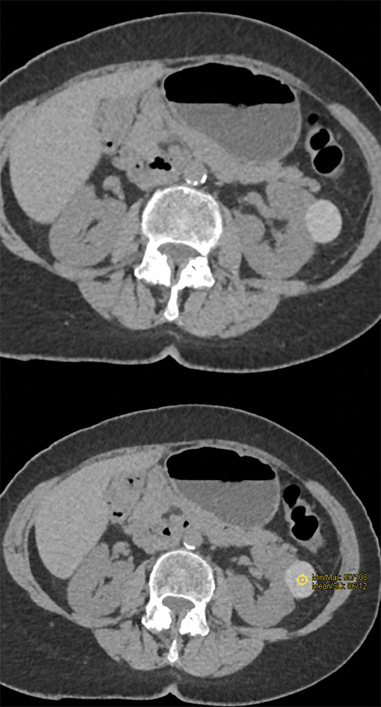 High Density Renal Cyst