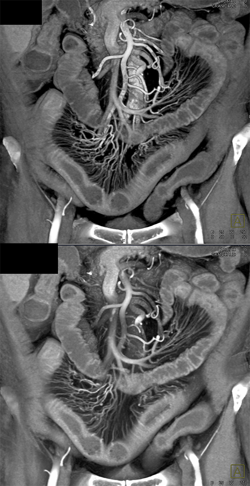 CT of Small Bowel Obstruction