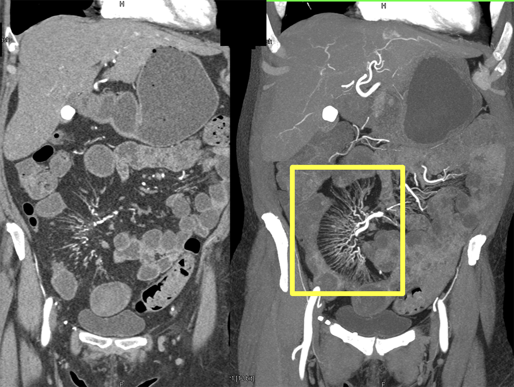 CT of Small Bowel Obstruction