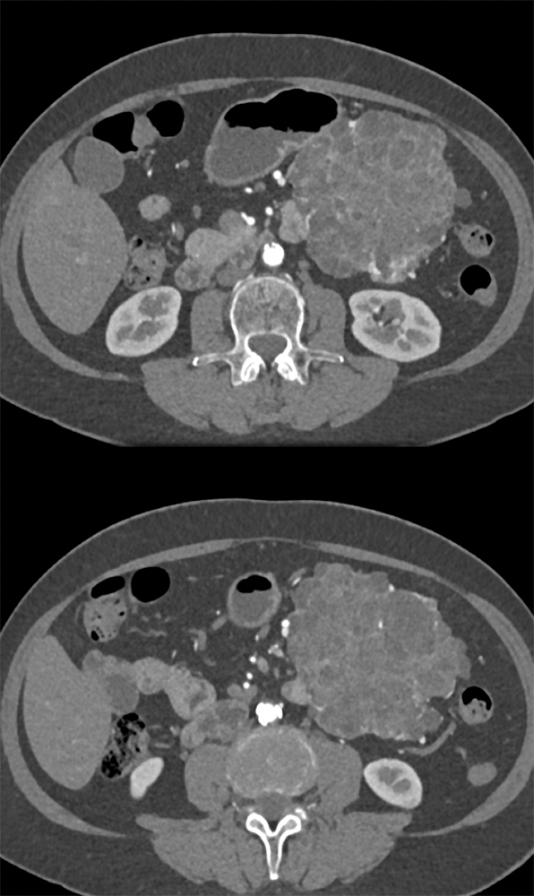 Serous Cystadenoma with Multiple Small Cysts