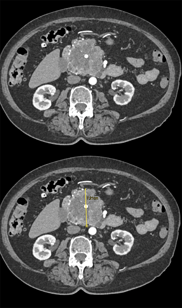Pancreas Mass Detected for r/o Dissection