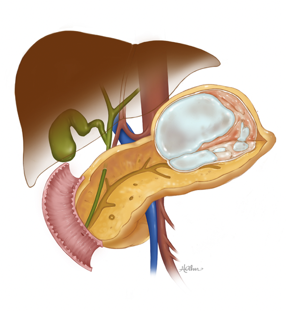 Serous Cystadenoma of the Pancreas