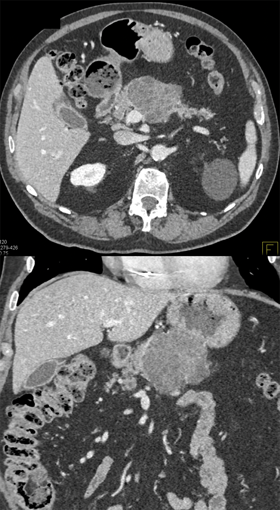 Serous Cystadenoma of the Pancreas