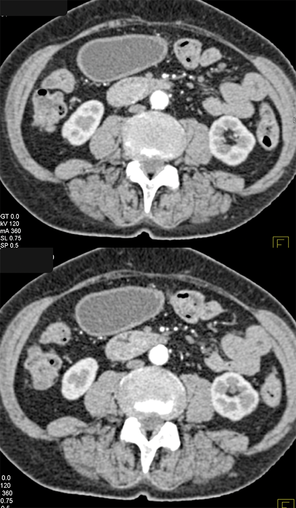 Duodenal Carcinoma Arising in a Villous Adenoma
