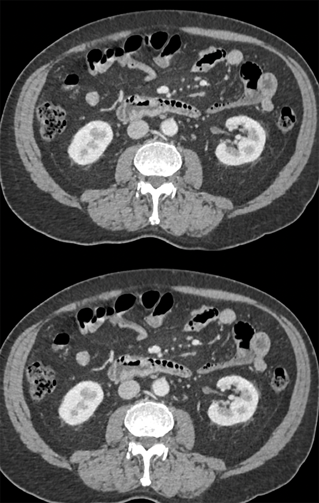 Duodenal Adenocarcinoma