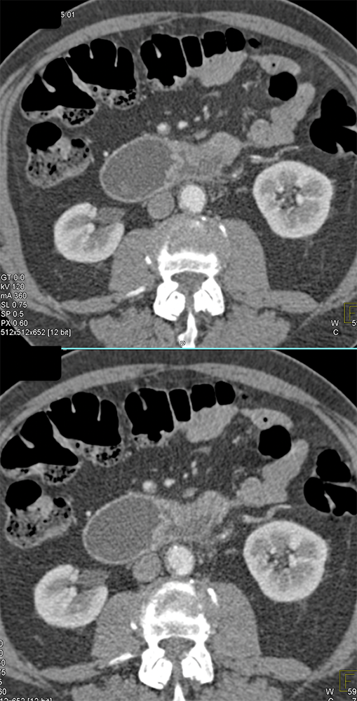 CT of Small Bowel Tumors