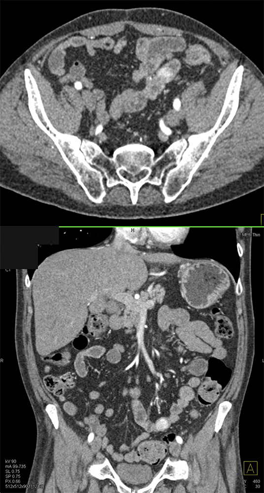 RCC Metastatic to Small Bowel