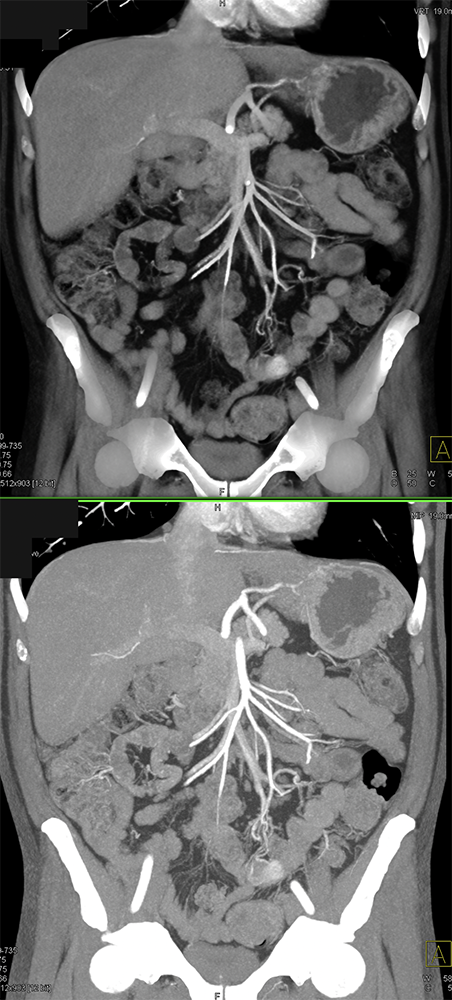 CT of Small Bowel Tumors