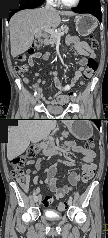 CT of Small Bowel Tumors