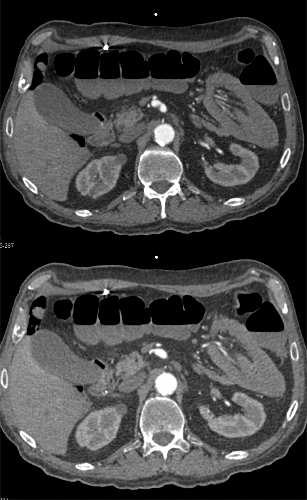 Metastatic Melanoma to the Small Bowel with Intussuception