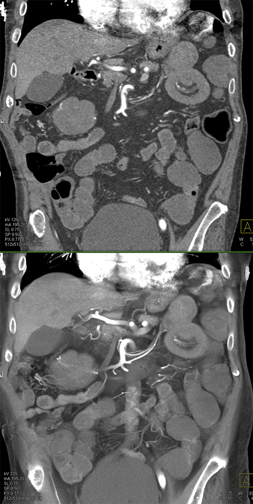 CT of Small Bowel Tumors