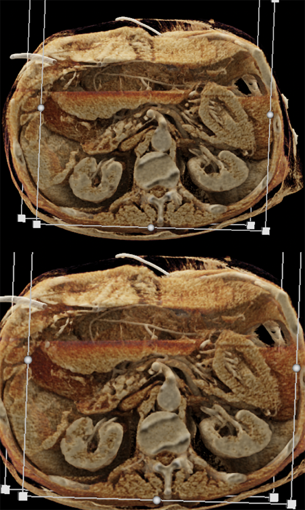 CT of Small Bowel Tumors