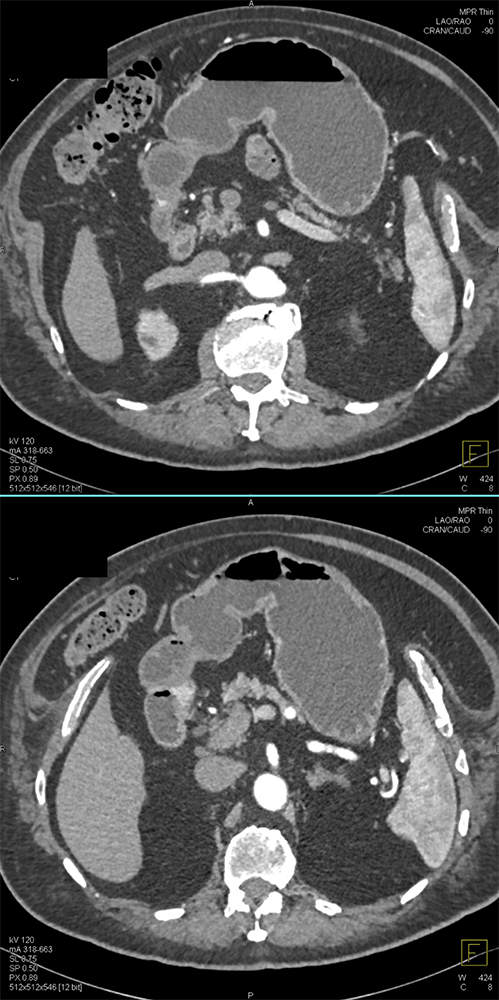 Do you see the duodenal mass?