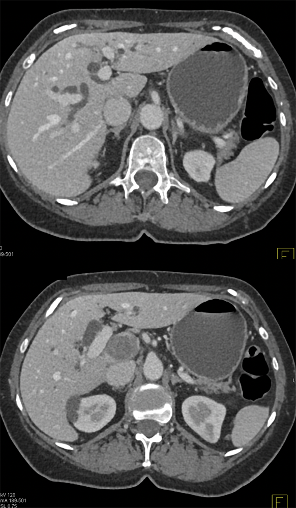 Metastatic Melanoma to Duodenum Simulates a Pancreatic Mass